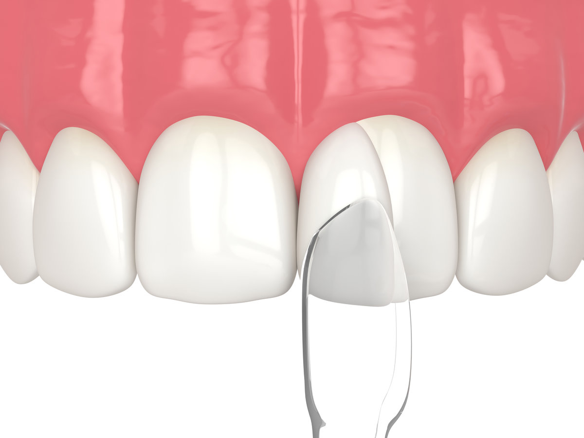 3d render of tooth reshaped by composite resin adm matrix over white. Crooked tooth rebuilding concept.